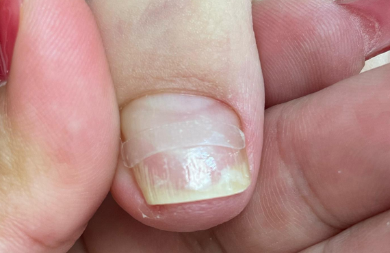 印西市のネイルサロン｜痛くない巻き爪ケアができるcoco-nail